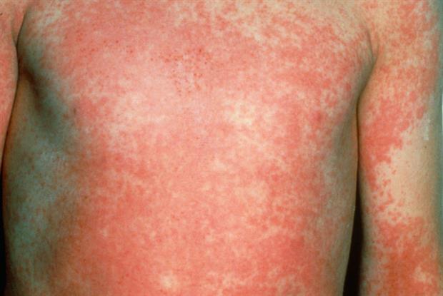 scarlet-fever-cases-soar-to-new-high-gponline