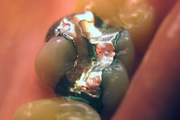 Dentists' views have long been split on the risks of amalgam fillings. Photograph: Kauzio