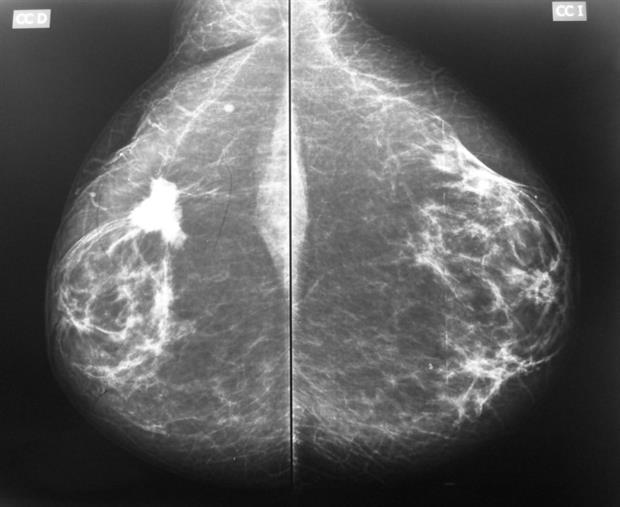 BPA substitute bisphenol S has been found to promote the growth of breast cancer cells. Photograph: SCiardullo CC BY-SA 4.0