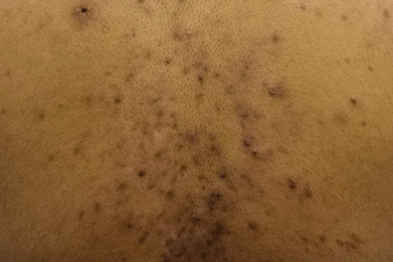 Clinical Review - Acne vulgaris | GPonline