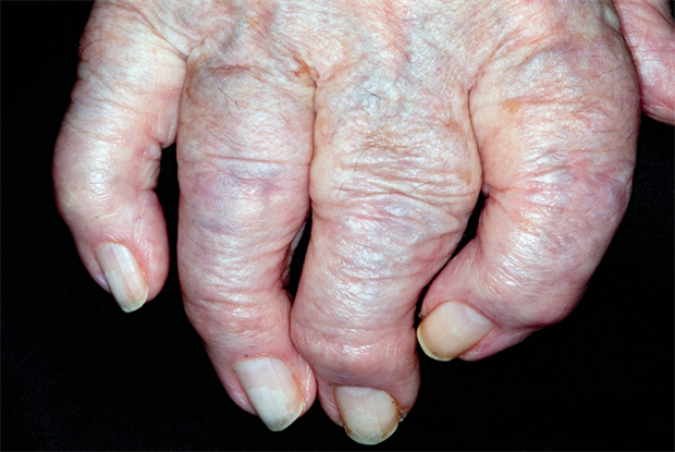 Osteoarthritis in primary care: early diagnosis and management | GPonline