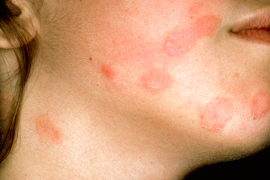 Pictorial case study: Facial rash | GPonline