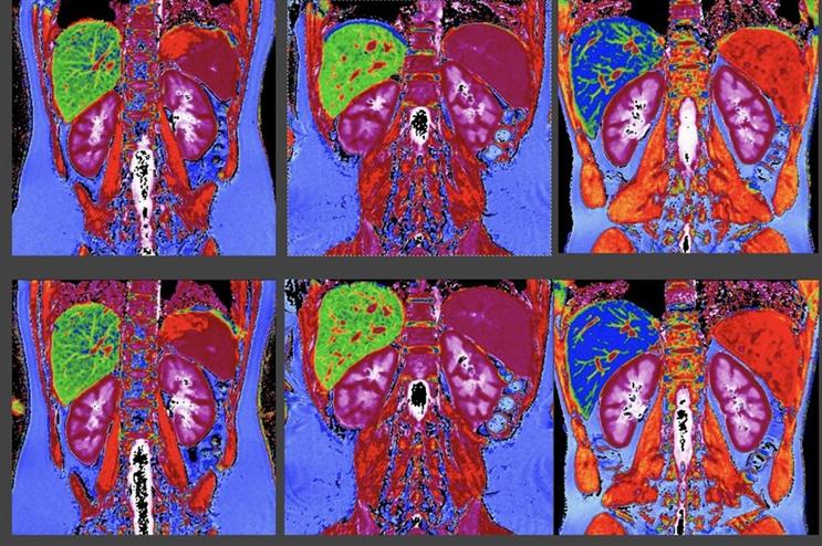 Perspectum develops non-invasive diagnostic tools such as this kidney scan