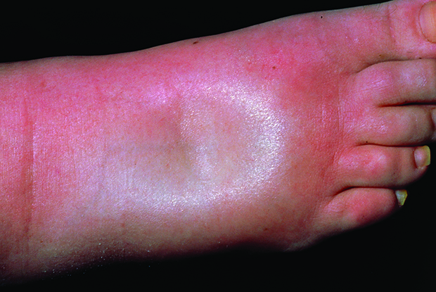 Oedema Red Flag Symptoms GPonline