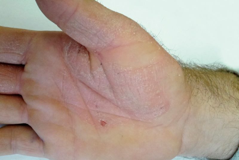 Contact dermatitis (Dr Suneeta Kochhar)