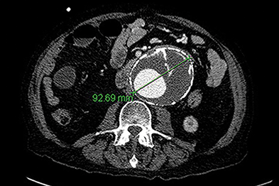 CT scan showing an abdominal aortic aneurysm (Author Image)