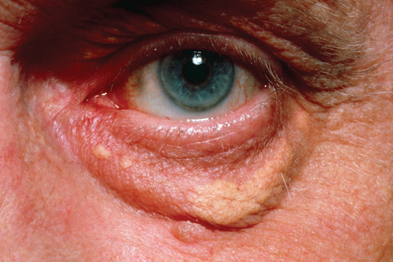 Xanthelasma predicts the risk of MI, IHD, severe atherosclerosis and death in the general population (Photograph: SPL)