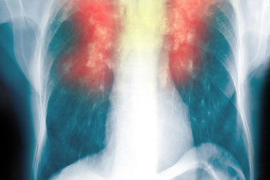 COPD: NICE guidance is changing
