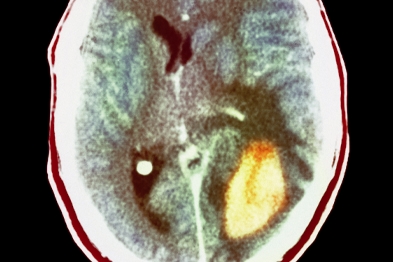 CT scan showing a rapidly growing glioma (yellow) (Photograph: SPL)