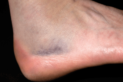 Fractured ankle: use a stepwise strategy for analgesia use (Photograph: SPL)