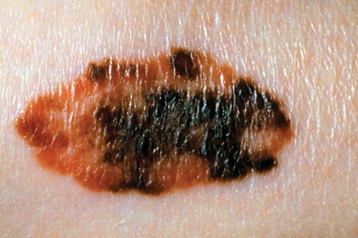 Dabrafenib and trametinib were tried as a combined treatment for melanoma (Photograph: Dr P Marazzi/SPL)