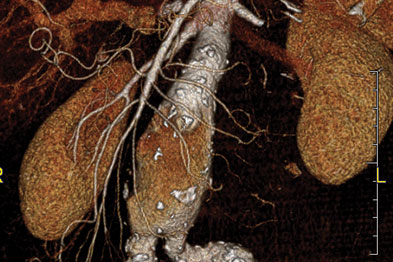Three-dimensional CT reconstruction: large AAA extending to iliac arteries
