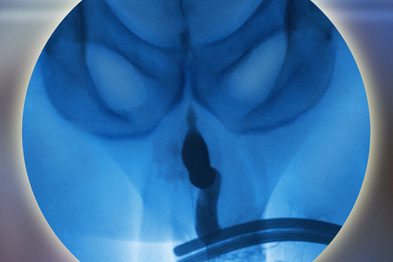 There is no particular approach to treating anterior urethral injuries 