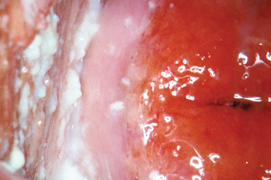 Vaginal candidiasis may present with lumpy discharge and swelling (Photograph: ISM/SPL)
