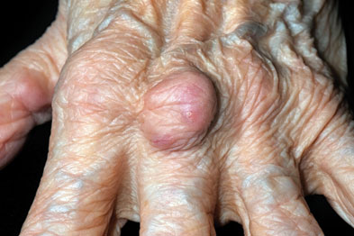 Rheumatoid arthritis: elevated rheumatoid factor suggests the need for specialist referral (Photograph: Dr P Marazzi/SPL)