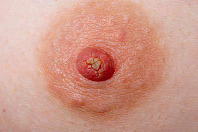 Intraductal papilloma with cancer, Intraductal papilloma treatment