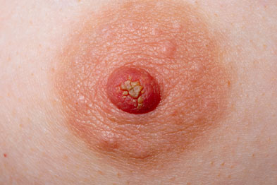 intraductal papilloma nhs