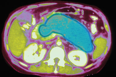 Pancreatitis (blue) is most often caused by gallstones or alcohol abuse (Photograph: SPL)