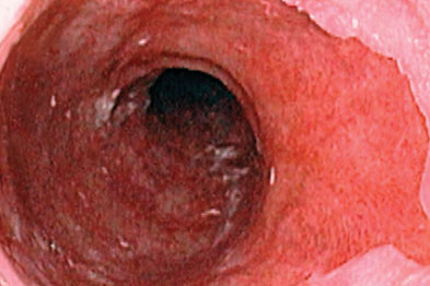 Patients with Barrett’s oesophagus (above) had a higher risk of oesophageal adenocarcinoma (Photograph: SPL)
