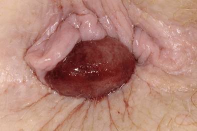 External haemorrhoids always feature a prolapse which is typically very painful (Photograph: SPL)