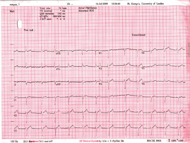 ecg interpretation practice free