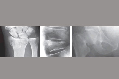 Typical sites of osteoporotic fracture: wrist (left), spine (centre) and hip (right)