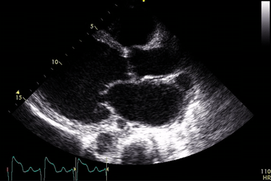 Still image of transthoracic echocardiogram in DCM showing a dilated left ventricle (Photograph: Dr Raj Thakkar)