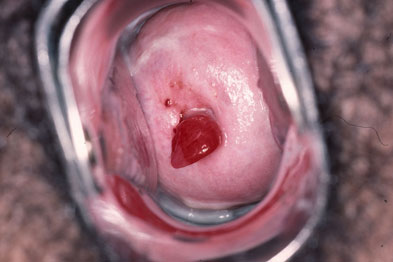 Endocervical polyps should be removed and sent for histology