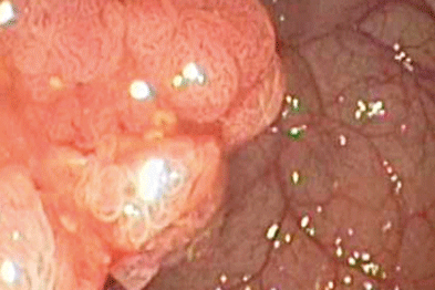 Rectal adenicarcinoma (Photograph: SPL)