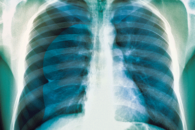 Breathlessness was due to a right-sided pneumothorax (Photograph: SPL)