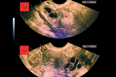 Ultrasonography is the main imaging modailty for investigating ovarian cysts (Photograph: SPL)