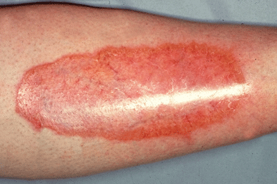 necrobiosis lipoidica causes