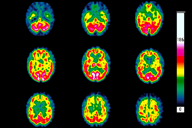 Scans of Huntington's disease showing neuronal loss (green areas) (Photograph: SPL)
