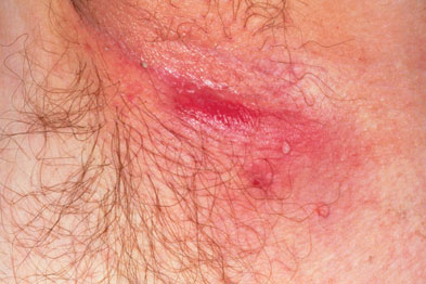 Hidradenitis suppurativa: blocked apocrine sweat glands and hair follicles become inflamed and infected