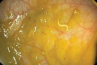 pinworm dermatitis