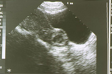 Ultrasound image showing an ectopic pregnancy occurring in the right Fallopian tube (Photograph: SPL)