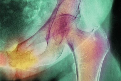 Patients diagnosed with heart failure increased risk of hip fracture