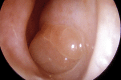 intranasal polyps