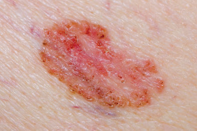Indoor tanning was associated with an increased risk of basal cell carcinoma (Photograph: Dr P Marazzi/SPL)