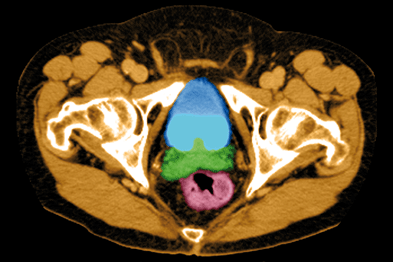 prostatitis patient reviews