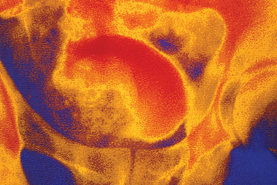 False colour IV urogram of enlarged prostate (gold shadow) (Photograph: SPL)
