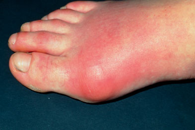 Reclassifying Gout Subtypes Would Help Improve Therapy Gponline