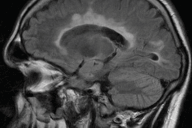 MRI showing demyelination spreading outwards from the ventricles (Photograph: Dr O Lily)