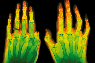 Charities have urged GPs to not forget conditions such as arthritis (Photograph: SPL)
