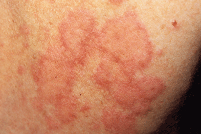 Urticaria presents as weals with erythema (Photograph: SPL)