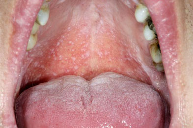 Oral lichen planus: white patches form inside the mouth