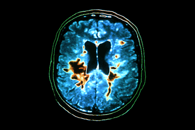 Central neuropathic pain can be associated with multiple sclerosis (Photograph: SPL)
