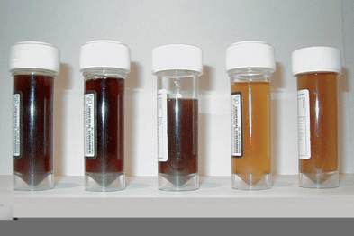 The classical symptom seen in PNH is haemoglobinuria (black urine) (Photograph: Professor P Hillmen)