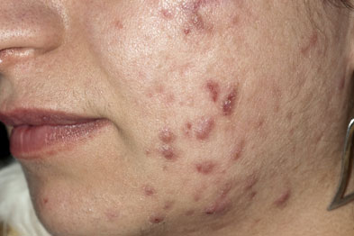 Acne vulgaris may lead to scarring once the inflammation subsides