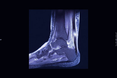 Achilles tendon rupture is an uncommon side-effect